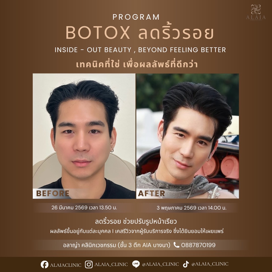 Botox Real Result 1